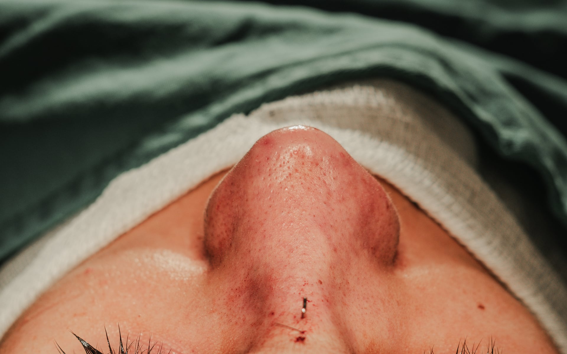 Rinoplastia